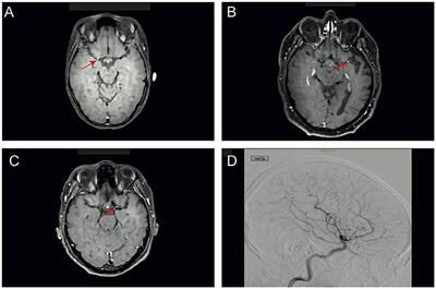 Cerebrospinal Fluid Concentrations of Neuronal Proteins Are Reduced in Primary Angiitis of the Central Nervous System